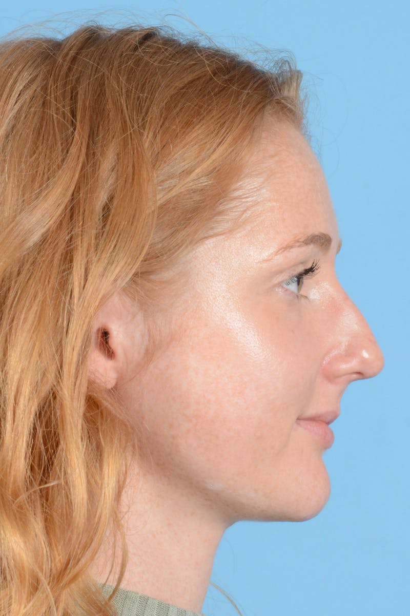 Rhinoplasty Before & After Gallery - Patient 146698158 - Image 5