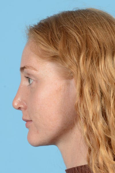 Rhinoplasty Before & After Gallery - Patient 146698158 - Image 10