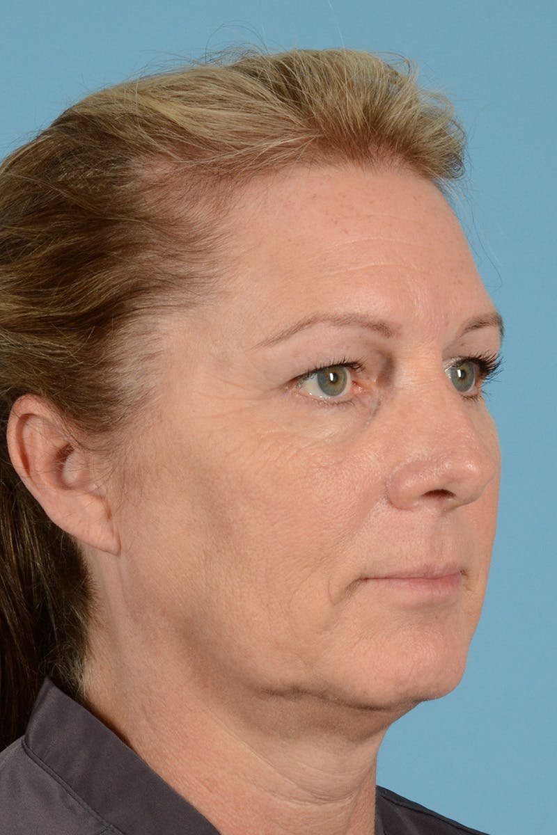 Brow Lift Before & After Gallery - Patient 146698206 - Image 3