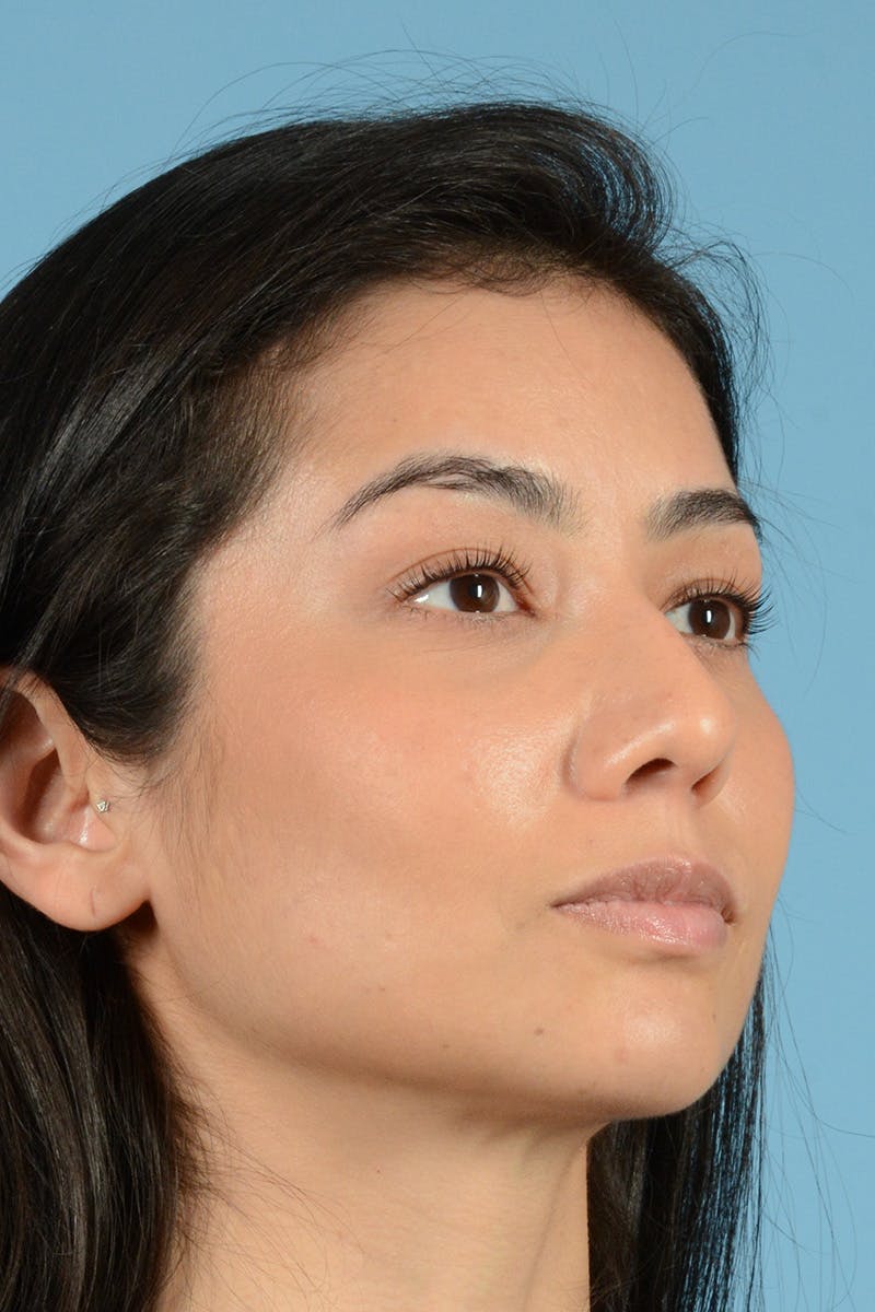 Rhinoplasty Before & After Gallery - Patient 146698160 - Image 3
