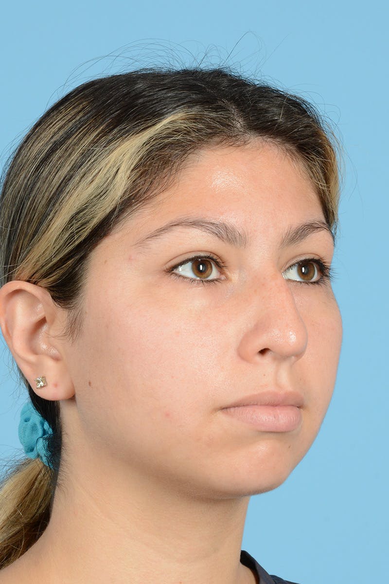 Rhinoplasty Before & After Gallery - Patient 146698164 - Image 3