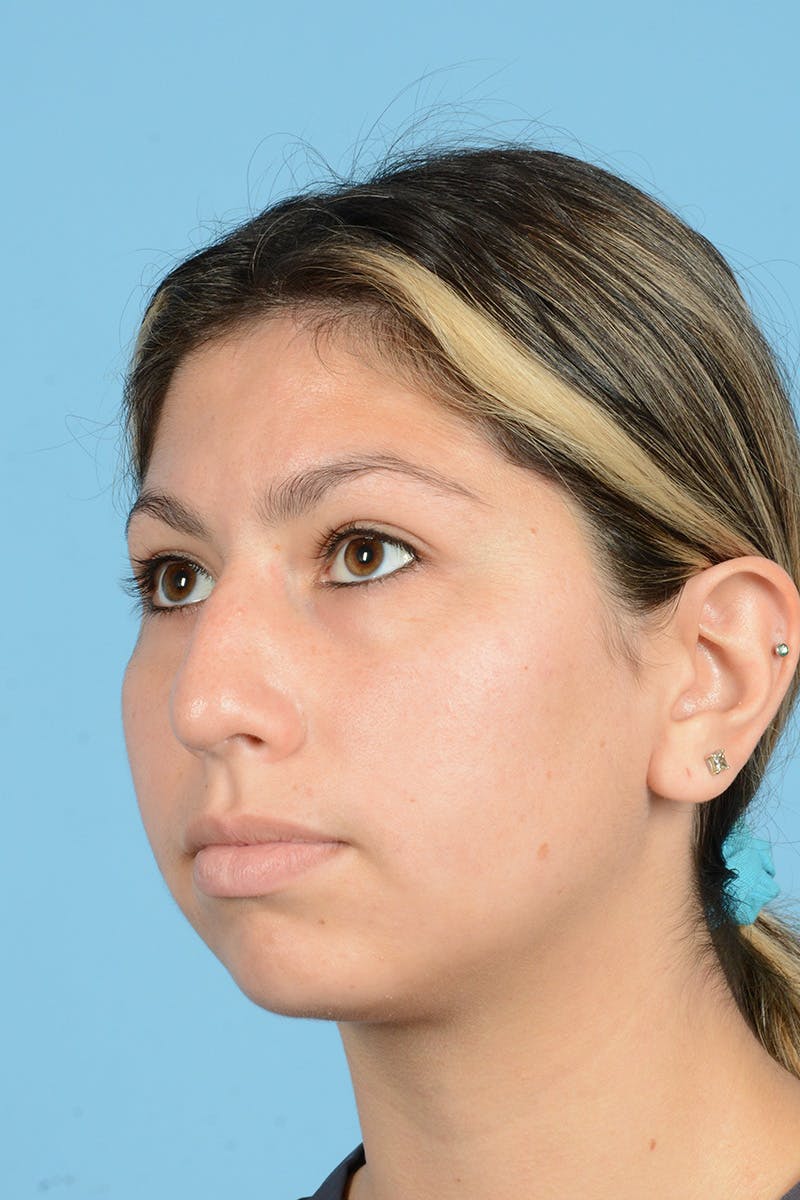 Rhinoplasty Before & After Gallery - Patient 146698164 - Image 7