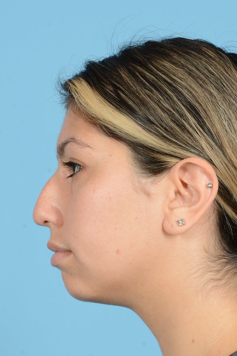 Rhinoplasty Before & After Gallery - Patient 146698164 - Image 9