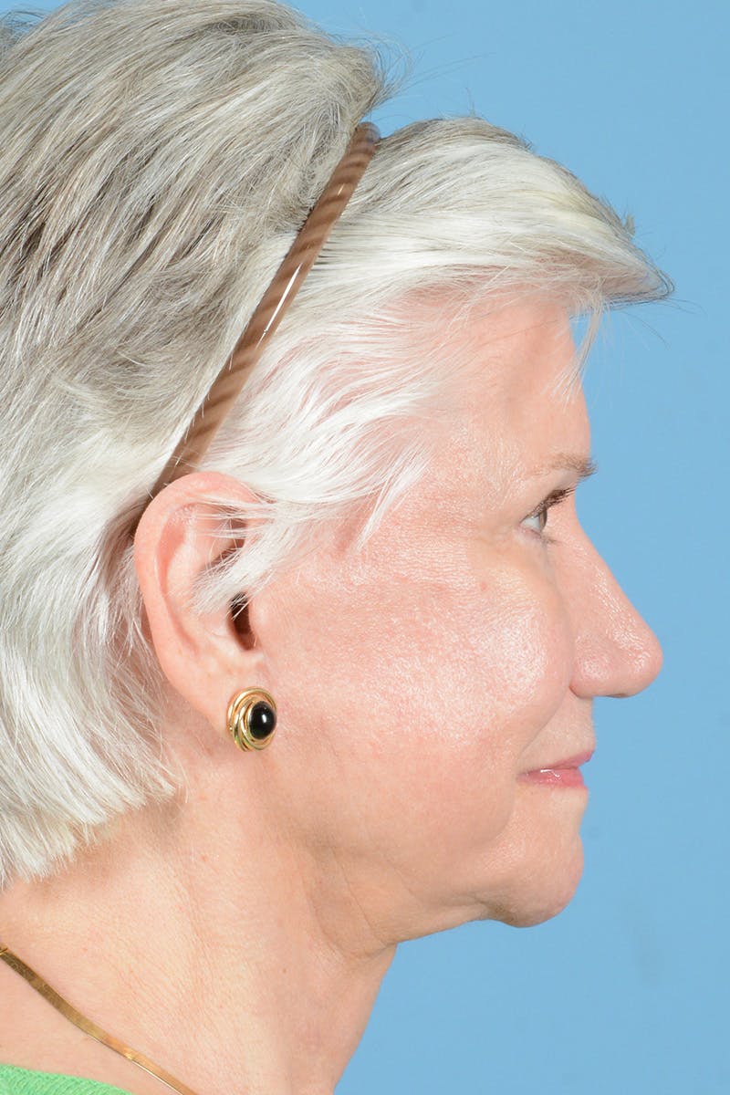 Facial Augmentation Before & After Gallery - Patient 146698210 - Image 6
