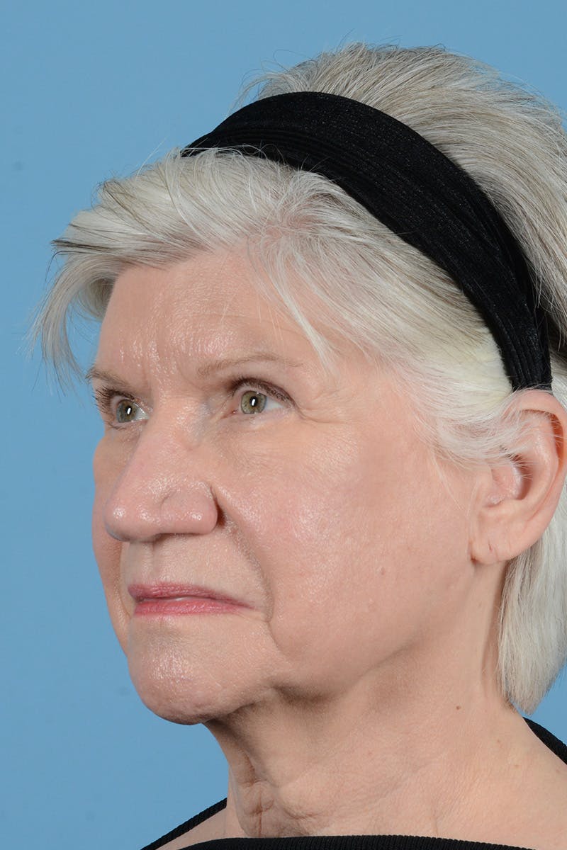 Facial Augmentation Before & After Gallery - Patient 146698210 - Image 7