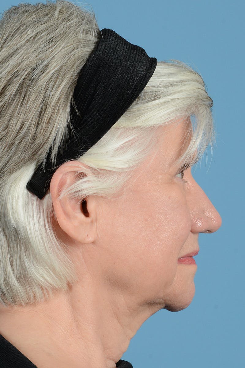 Facial Augmentation Before & After Gallery - Patient 146698210 - Image 5