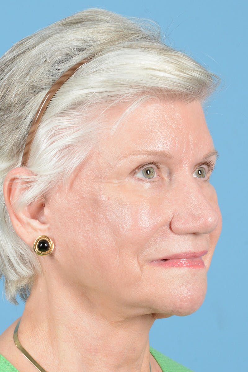 Facial Augmentation Before & After Gallery - Patient 146698210 - Image 4