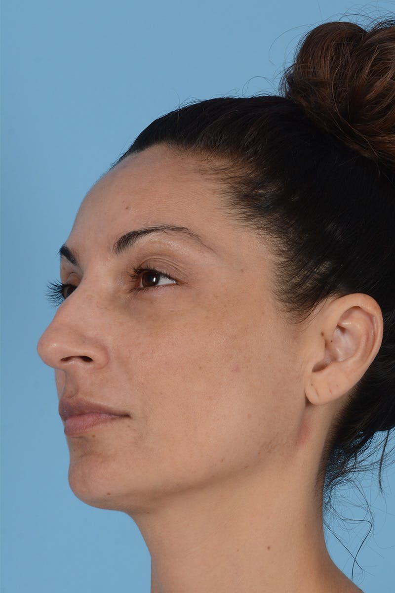 Rhinoplasty Before & After Gallery - Patient 146698167 - Image 7