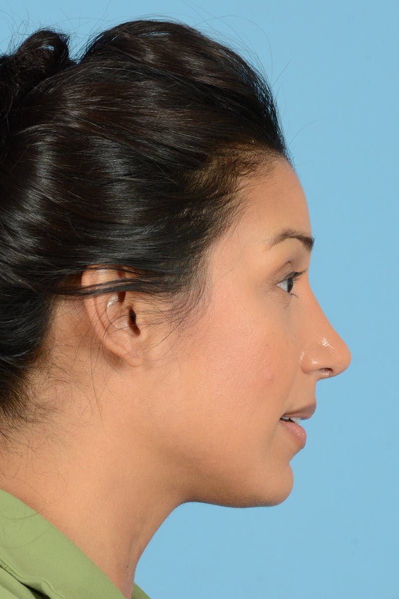 Rhinoplasty Before & After Gallery - Patient 146698169 - Image 6
