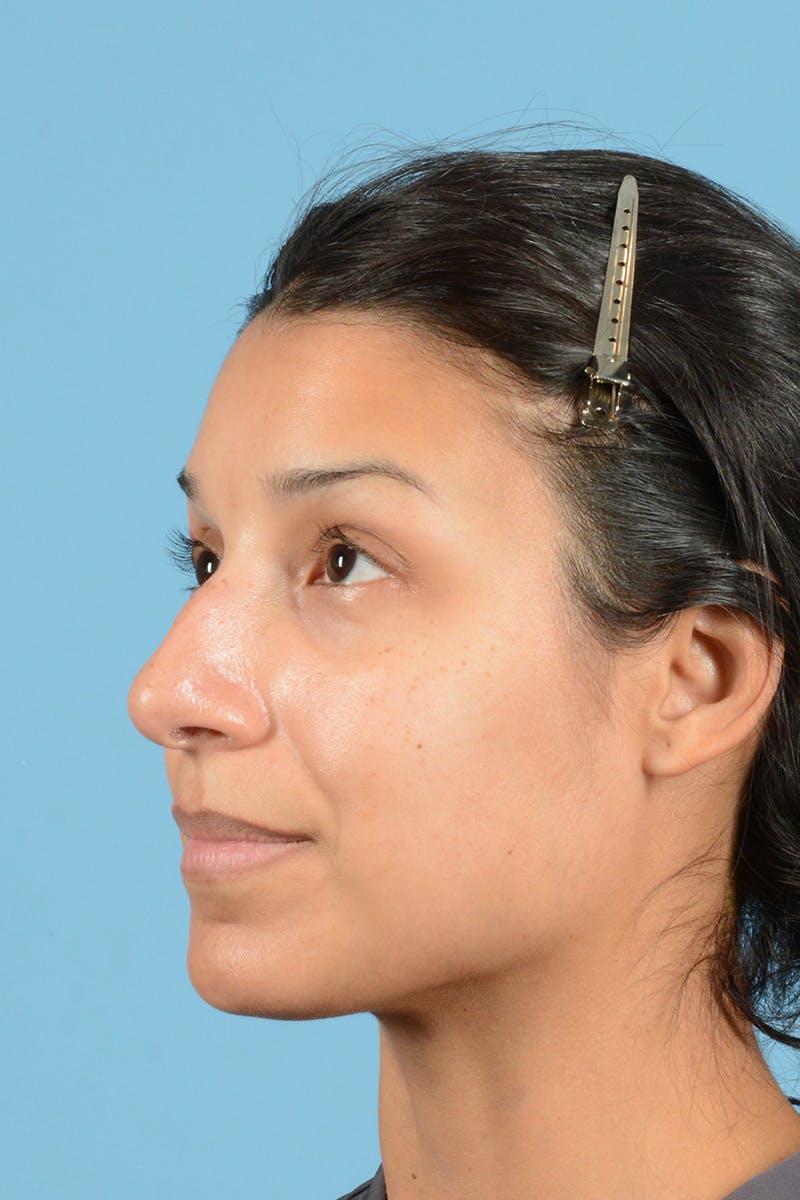 Rhinoplasty Before & After Gallery - Patient 146698169 - Image 7