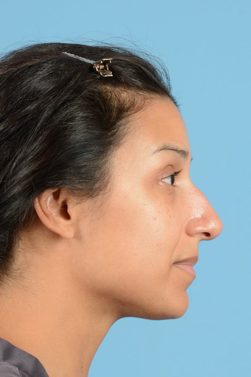 Rhinoplasty Before & After Gallery - Patient 146698169 - Image 5