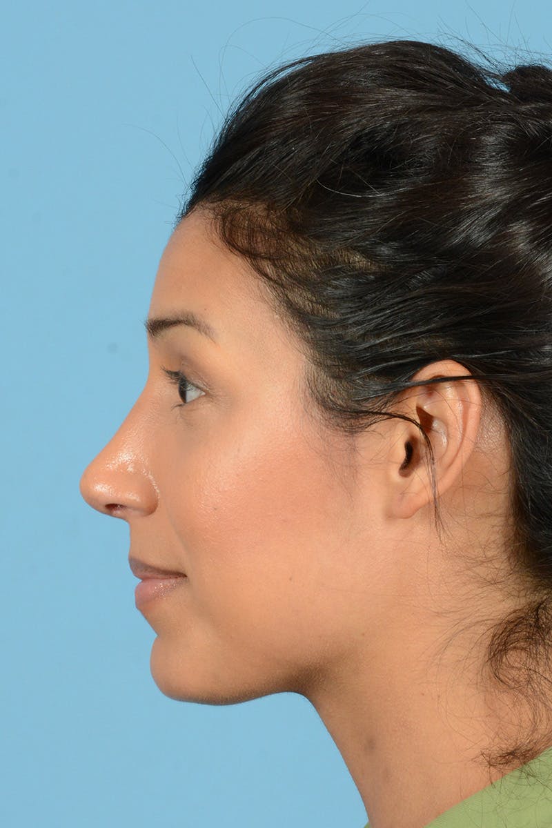Rhinoplasty Before & After Gallery - Patient 146698169 - Image 10