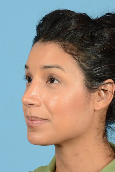 Rhinoplasty Before & After Gallery - Patient 146698169 - Image 8