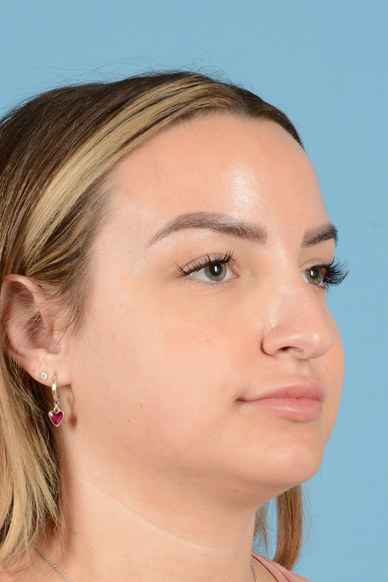 Rhinoplasty Before & After Gallery - Patient 146698171 - Image 3