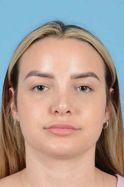 Rhinoplasty Before & After Gallery - Patient 146698171 - Image 2