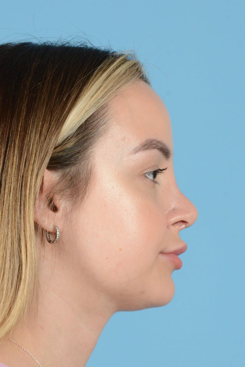 Rhinoplasty Before & After Gallery - Patient 146698171 - Image 6