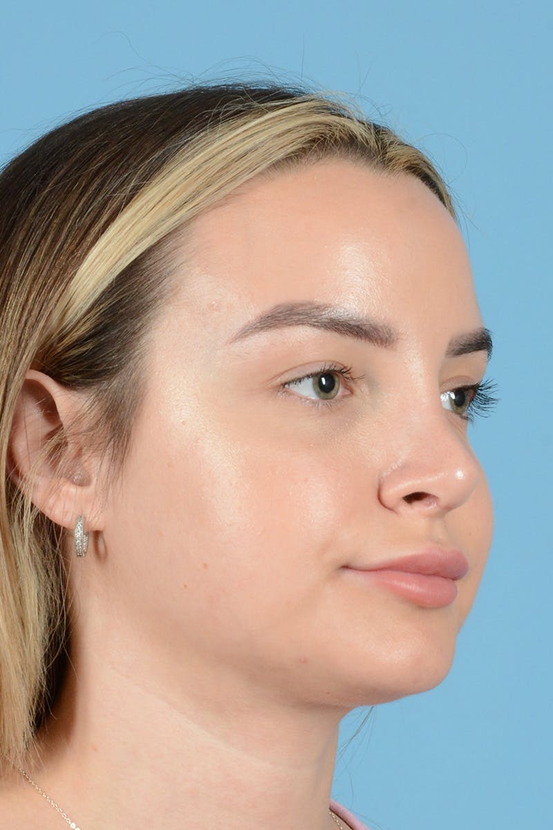 Rhinoplasty Before & After Gallery - Patient 146698171 - Image 4