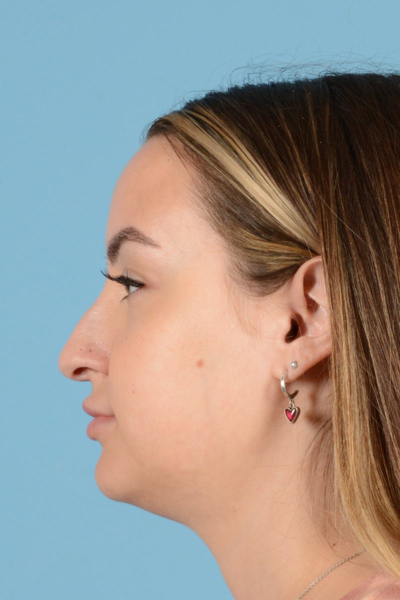 Rhinoplasty Before & After Gallery - Patient 146698171 - Image 9