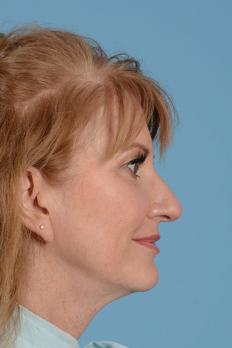 Rhinoplasty Before & After Gallery - Patient 146698172 - Image 5