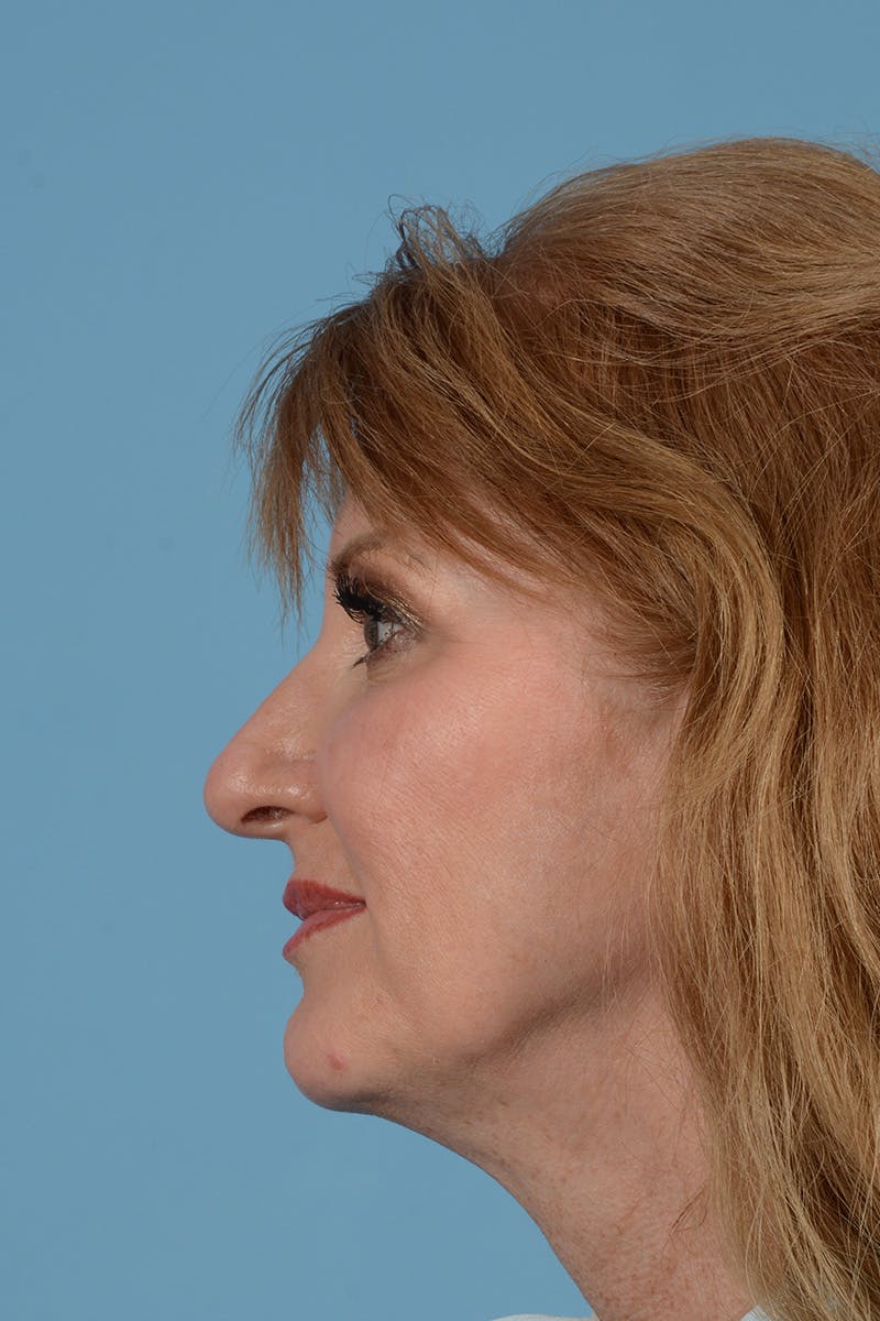 Rhinoplasty Before & After Gallery - Patient 146698172 - Image 9