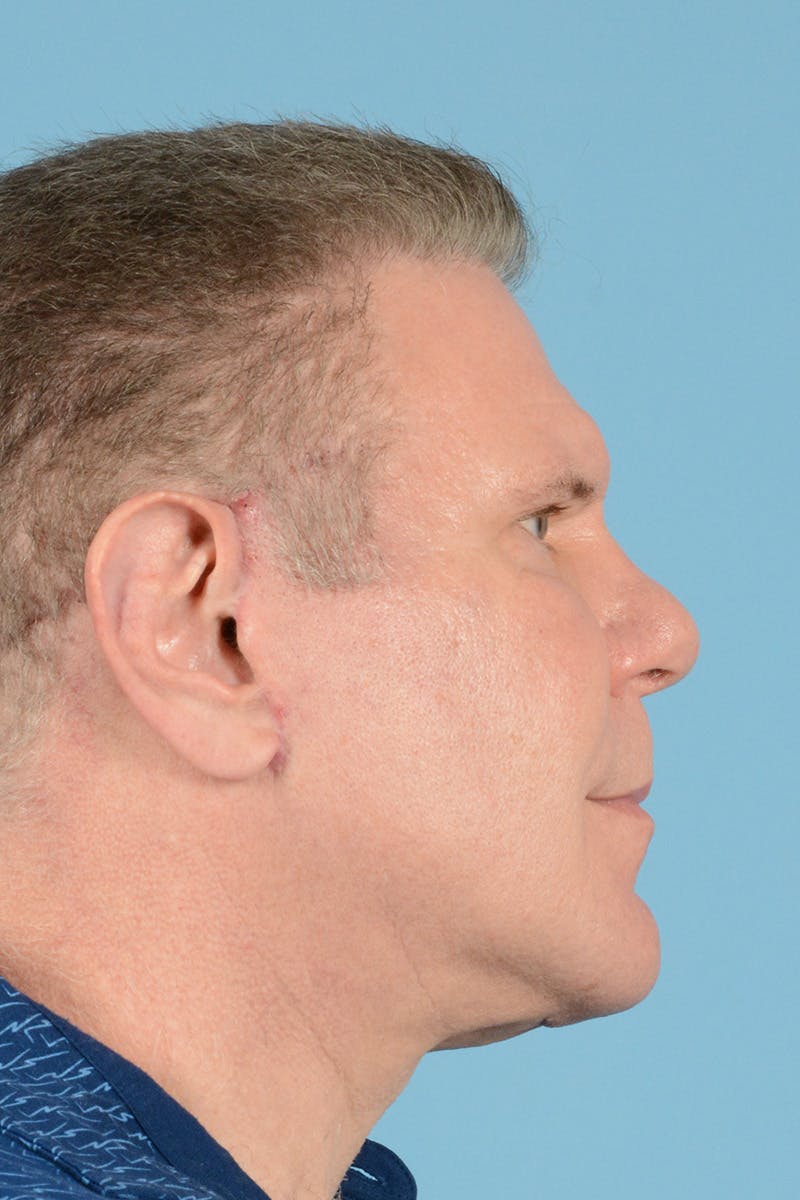 Neck Lift Before & After Gallery - Patient 146698245 - Image 6