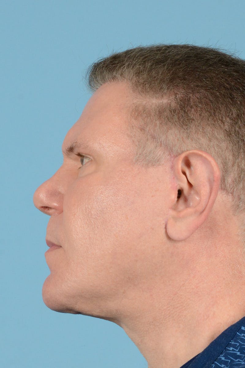Neck Lift Before & After Gallery - Patient 146698245 - Image 10