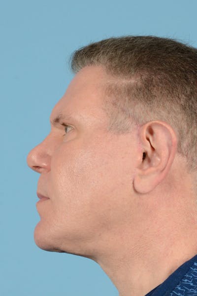 Facelift Before & After Gallery - Patient 146698244 - Image 10