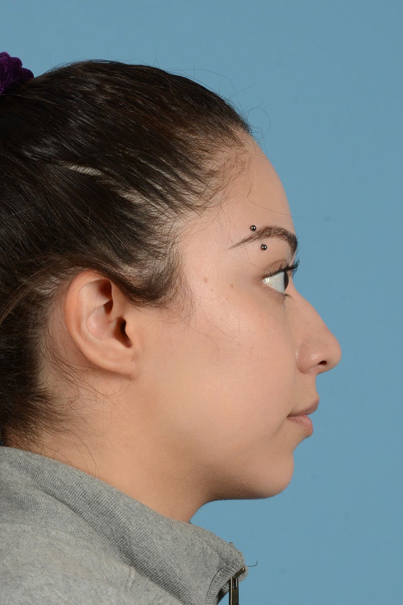 Rhinoplasty Before & After Gallery - Patient 146698174 - Image 5