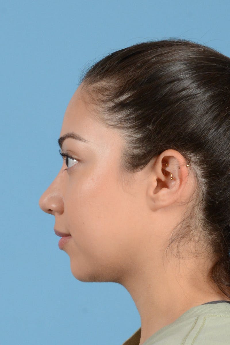 Rhinoplasty Before & After Gallery - Patient 146698174 - Image 10
