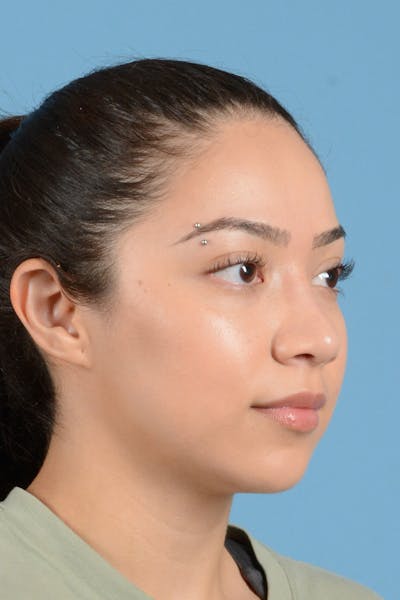 Rhinoplasty Before & After Gallery - Patient 146698174 - Image 4