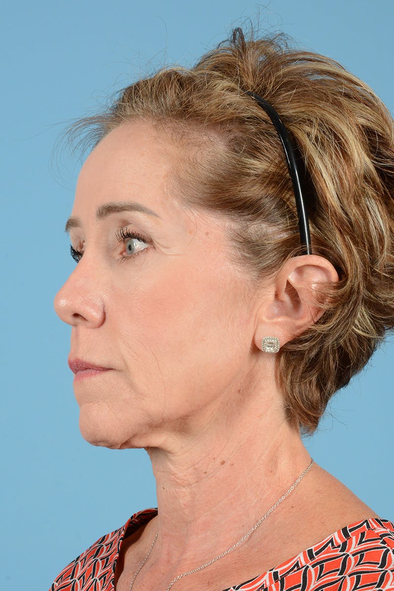 Facelift Before & After Gallery - Patient 148646337 - Image 7