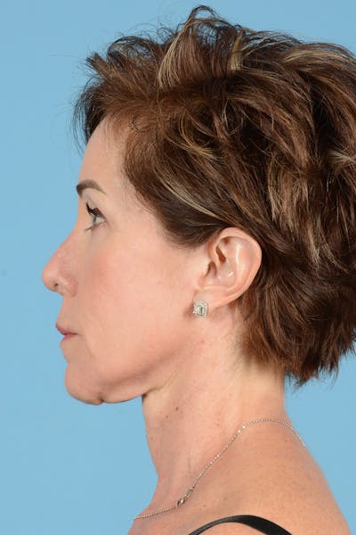 Neck Lift Before & After Gallery - Patient 148646338 - Image 10
