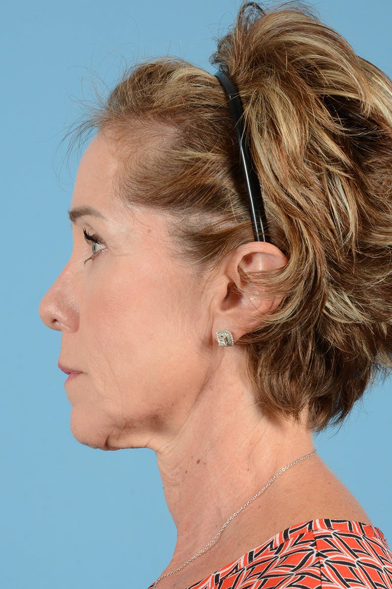 Facial Augmentation Before & After Gallery - Patient 148646335 - Image 9