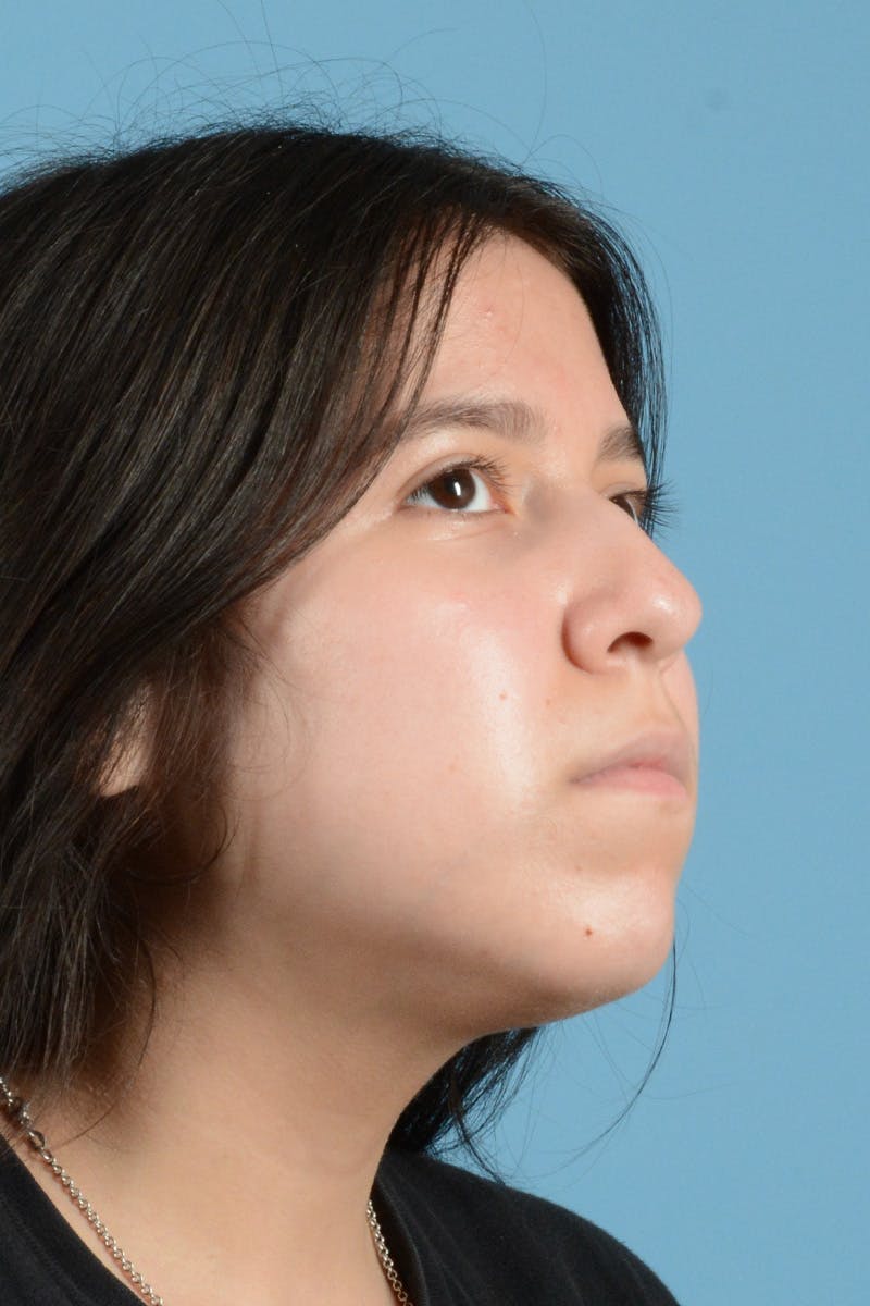 Rhinoplasty Before & After Gallery - Patient 148646315 - Image 3