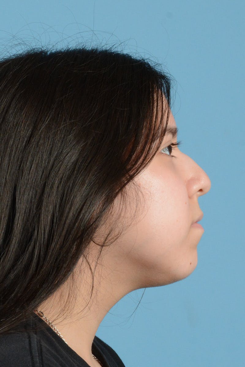 Facial Augmentation Before & After Gallery - Patient 148646316 - Image 5
