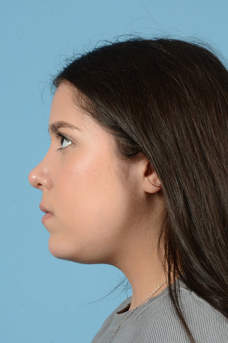Rhinoplasty Before & After Gallery - Patient 148646315 - Image 10