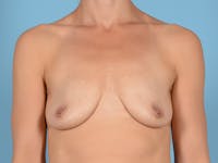 Breast Lift Before & After Gallery - Patient 148646452 - Image 1
