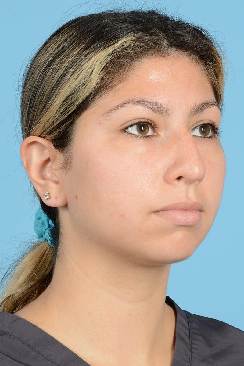 Rhinoplasty Before & After Gallery - Patient 148646469 - Image 3
