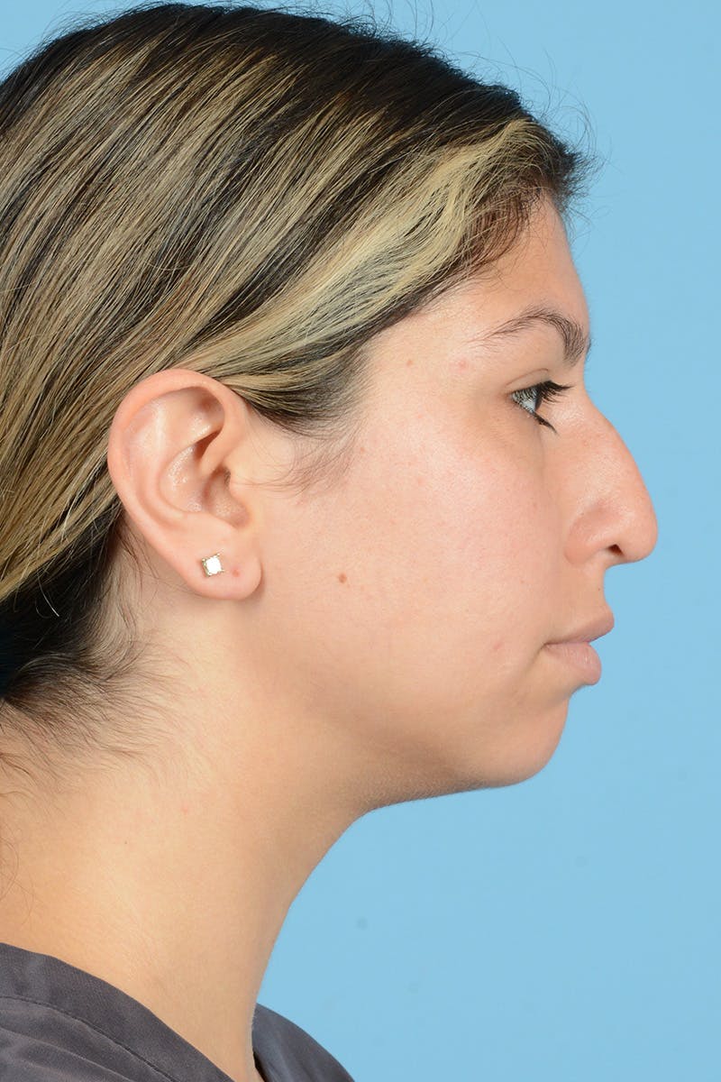 Rhinoplasty Before & After Gallery - Patient 148646469 - Image 5