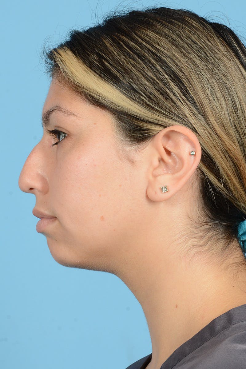 Rhinoplasty Before & After Gallery - Patient 148646469 - Image 9