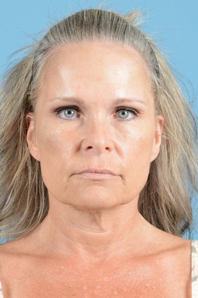 Brow Lift Before & After Gallery - Patient 148646442 - Image 1