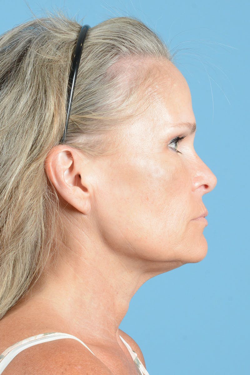 Neck Lift Before & After Gallery - Patient 148646441 - Image 5