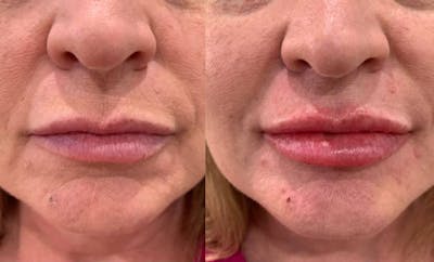 Fillers Before & After Gallery - Patient 166736273 - Image 1