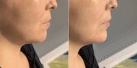 Fillers Before & After Gallery - Patient 166736275 - Image 1