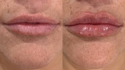 Fillers Before & After Gallery - Patient 166736280 - Image 1