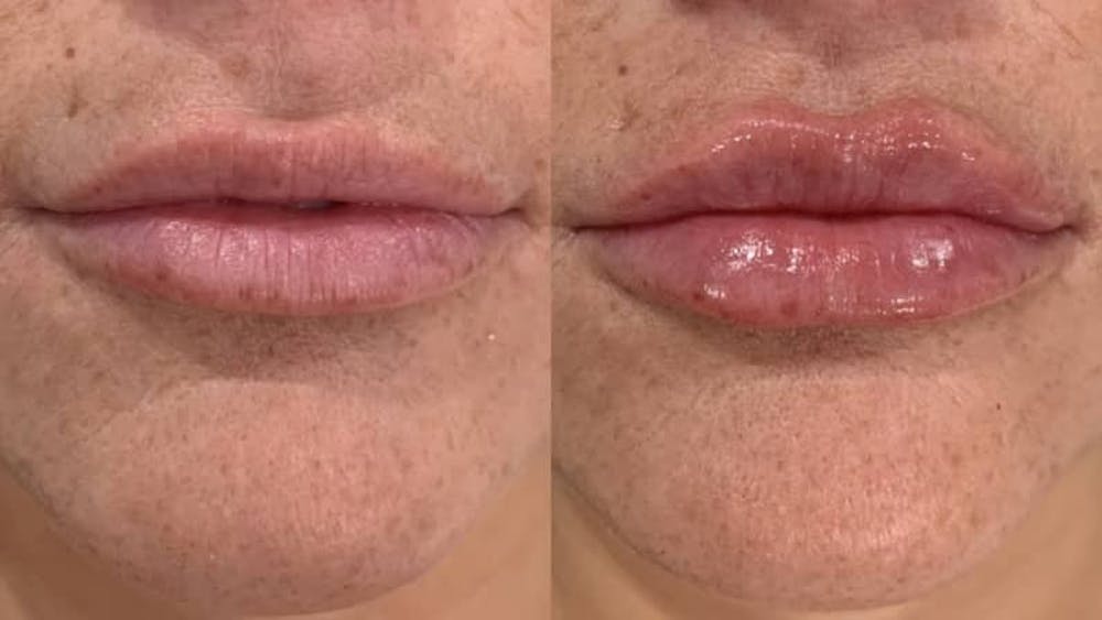 Fillers Before & After Gallery - Patient 166736280 - Image 1