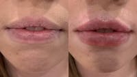 Fillers Before & After Gallery - Patient 166736866 - Image 1