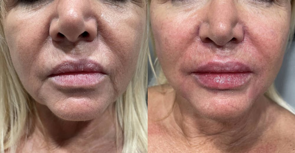 Fillers Before & After Gallery - Patient 166736868 - Image 1