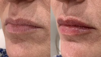 Fillers Before & After Gallery - Patient 166736869 - Image 1
