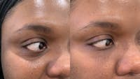 Fillers Before & After Gallery - Patient 166736870 - Image 1